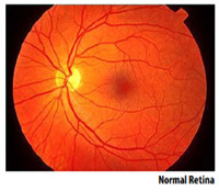 image of normal retina