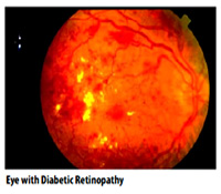 image of Eye with Diabetic Retinopathy